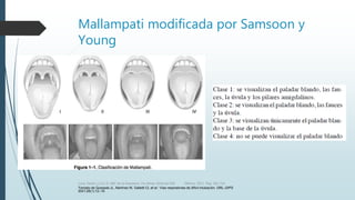 Mallampati modificada por Samsoon y
Young
Tomado de Quesada JL, Martínez M, Galletti CL et al.: Vías respiratorias de difícil intubación. ORL–DIPS
2001;28(1):12–19.
Luna, Pastor y Col. EL ABC de la Anestesia. Vía Aérea. Editorial Alfil. México. 2011. Pág. 183-214.
 