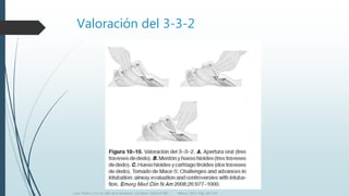 Valoración del 3-3-2
Luna, Pastor y Col. EL ABC de la Anestesia. Vía Aérea. Editorial Alfil. México. 2011. Pág. 183-214.
 