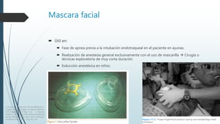 Mascara facial
 Útil en:
 Fase de apnea previa a la intubación endotraqueal en el paciente en ayunas.
 Realización de anestesia general exclusivamente con el uso de mascarilla  Cirugía o
técnicas exploratoria de muy corta duración.
 Inducción anestésica en niños.
1. Grupo CTO. Manual CTO de Medicina y
Cirugía. Anestesiología. Vía aérea. Editorial
CTO. Madrid. 2014. Pág. 7-16. 2. Vacanti,
Chales A. et al. Essential Clinical Anesthesia.
Airway Management. New York. Cambrige
University Press. 2011. Pag. 95-120.
 