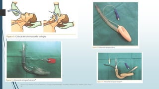 Grupo CTO. Manual CTO de Medicina y Cirugía. Anestesiología. Vía aérea. Editorial CTO. Madrid. 2014. Pág. 7-
16.
 