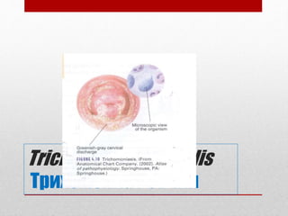 Trichomonas Vaginalis
Трихомониаз өвчин
 