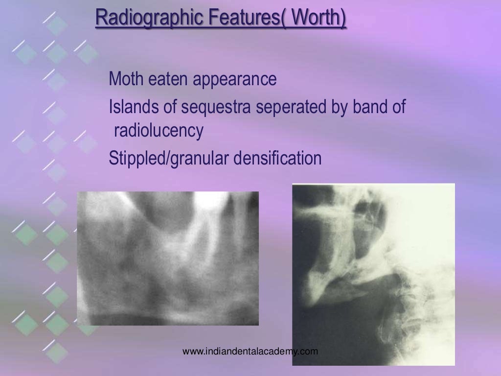 osteomyelitis of jaw bones / dental implant courses by Indian dental
