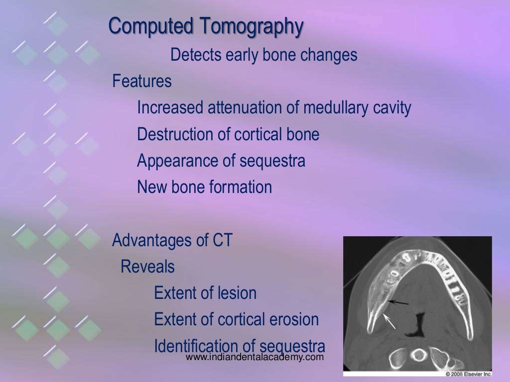 osteomyelitis of jaw bones / dental implant courses by Indian dental