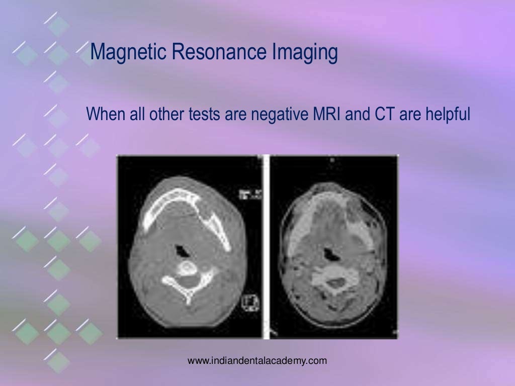 osteomyelitis of jaw bones / dental implant courses by Indian dental