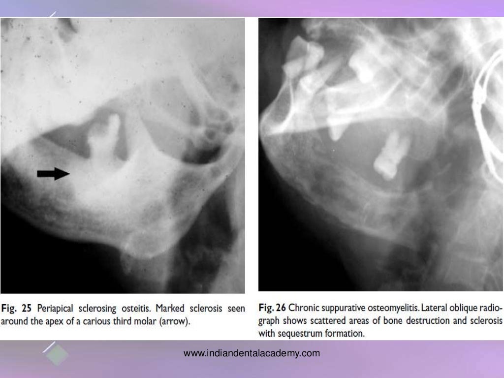 osteomyelitis of jaw bones / dental implant courses by Indian dental