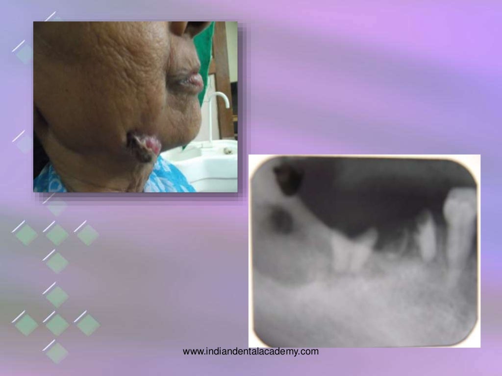 osteomyelitis of jaw bones / dental implant courses by Indian dental