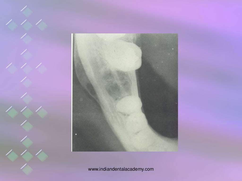 osteomyelitis of jaw bones / dental implant courses by Indian dental