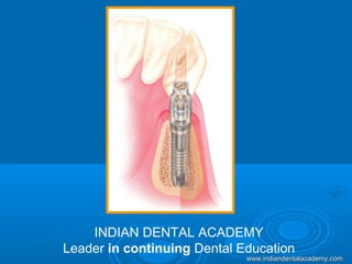 INDIAN DENTAL ACADEMY
Leader in continuing Dental Education
www.indiandentalacademy.comwww.indiandentalacademy.com
 