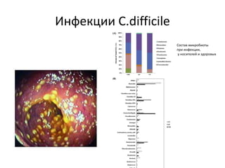 Инфекции C.difficile
Состав микробиоты
при инфекции,
у носителей и здоровых
 