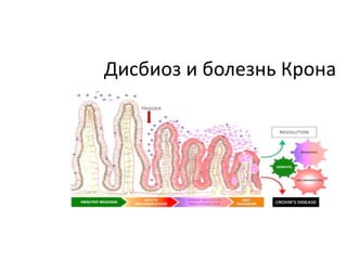 Дисбиоз и болезнь Крона
 
