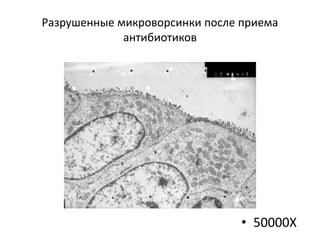 Разрушенные микроворсинки после приема
антибиотиков
• 50000X
 