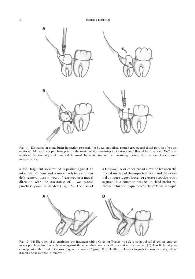 General Technique of Third Molar Removal
