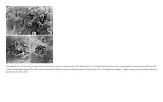 Scanning electron micrographs of experimental intestinal amebiasis in the guinea pig. (A) Trophozoites of E. histolytica adhere preferentially to the elevated interglandular epithelium. (B)
A small interglandular region of microinvasion is observed in the early invasive lesion with superficial ulceration. (C) In a more advanced stage of invasion, numerous trophozoites are seen
penetrating a colonic ulcer.
 