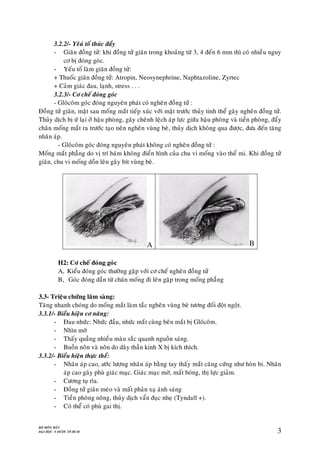 BOÄ MOÂN MAÉT
ÑAÏI HOÏC Y DÖÔÏC TP.HCM 3
3.2.2/- Yeâuù toá thuùc ñaåy
- Giaõn ñoàng töû: khi ñoàng töû giaõn trong khoaûng töø 3, 4 ñeán 6 mm thì coù nhieàu nguy
cô bò ñoùng goùc.
- Yeáu toá laøm giaõn ñoàng töû:
+ Thuoác giaõn ñoàng töû: Atropin, Neosynephrine, Naphtazoline, Zyrtec
+ Caûm giaùc ñau, laïnh, stress . . .
3.2.3/- Cô cheá ñoùng goùc
- Gloâcoâm goùc ñoùng nguyeân phaùt coù ngheõn ñoàng töû :
Ñoàng töû giaõn, maët sau moáng maét tieáp xuùc vôùi maët tröôùc thuûy tinh theå gaây ngheõn ñoàng töû.
Thuûy dòch bò öù laïi ôû haäu phoøng, gaây cheânh leäch aùp löïc giöõa haäu phoøng vaø tieàn phoøng, ñaåy
chaân moáng maét ra tröôùc taïo neân ngheõn vuøng beø, thuûy dòch khoâng qua ñöôïc, ñöa ñeán taêng
nhaõn aùp.
- Gloâcoâm goùc ñoùng nguyeân phaùt khoâng coù ngheõn ñoàng töû :
Moáng maét phaúng do vò trí baùm khoâng ñieån hình cuûa chu vi moáng vaøo theå mi. Khi ñoàng töû
giaõn, chu vi moáng doàn leân gaây bít vuøng beø.
A B
H2: Cô cheá ñoùng goùc
A, Kieåu ñoùng goùc thöôøng gaëp vôùi cô cheá ngheõn ñoàng töû
B, Goùc ñoùng daàn töø chaân moáng ñi leân gaëp trong moáng phaúng
3.3- Trieäu chöùng laâm saøng:
Taêng nhanh choùng do moáng maét laøm taéc ngheõn vuøng beø töông ñoái ñoät ngoät.
3.3.1/- Bieåu hieän cô naêng:
- Ñau nhöùc: Nhöùc ñaàu, nhöùc maét cuøng beân maét bò Gloâcoâm.
- Nhìn môø
- Thaáy quaàng nhieàu maøu saéc quanh nguoàn saùng.
- Buoàn noân vaø noân do daây thaàn kinh X bò kích thích.
3.3.2/- Bieåu hieän thöïc theå:
- Nhaõn aùp cao, öôùc löôïng nhaõn aùp baèng tay thaáy maét caêng cöùng nhö hoøn bi. Nhaõn
aùp cao gaây phuø giaùc maïc. Giaùc maïc môø, maát boùng, thò löïc giaûm.
- Cöông tuï rìa.
- Ñoàng töû giaõn meùo vaø maát phaûn xaï aùnh saùng
- Tieàn phoøng noâng, thuûy dòch vaån ñuïc nheï (Tyndall +).
- Coù theå coù phuø gai thò.
 