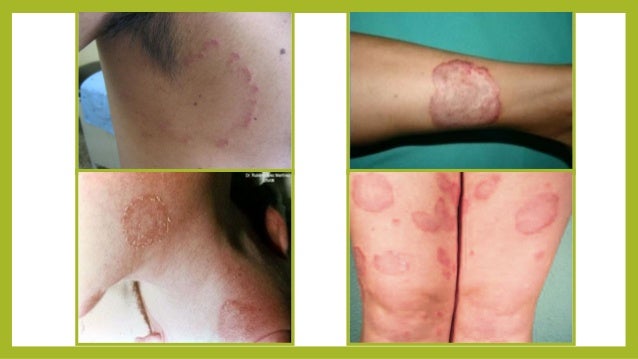 Micosis hongos en la piel y soluciones para eliminarlos y evitarlos