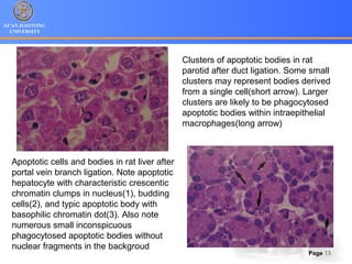 XI’AN JIAOTONG
UNIVERSITY
Page 13
Apoptotic cells and bodies in rat liver after
portal vein branch ligation. Note apoptotic
hepatocyte with characteristic crescentic
chromatin clumps in nucleus(1), budding
cells(2), and typic apoptotic body with
basophilic chromatin dot(3). Also note
numerous small inconspicuous
phagocytosed apoptotic bodies without
nuclear fragments in the backgroud
Clusters of apoptotic bodies in rat
parotid after duct ligation. Some small
clusters may represent bodies derived
from a single cell(short arrow). Larger
clusters are likely to be phagocytosed
apoptotic bodies within intraepithelial
macrophages(long arrow)
 