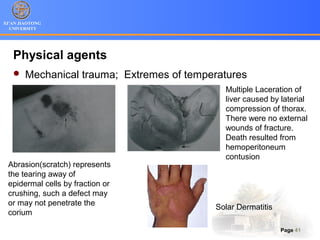 XI’AN JIAOTONG
UNIVERSITY
Page 41
Physical agents
 Mechanical trauma; Extremes of temperatures
Abrasion(scratch) represents
the tearing away of
epidermal cells by fraction or
crushing, such a defect may
or may not penetrate the
corium
Multiple Laceration of
liver caused by laterial
compression of thorax.
There were no external
wounds of fracture.
Death resulted from
hemoperitoneum
contusion
Solar Dermatitis
 