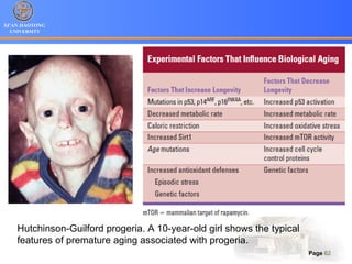 XI’AN JIAOTONG
UNIVERSITY
Page 62
Hutchinson-Guilford progeria. A 10-year-old girl shows the typical
features of premature aging associated with progeria.
 
