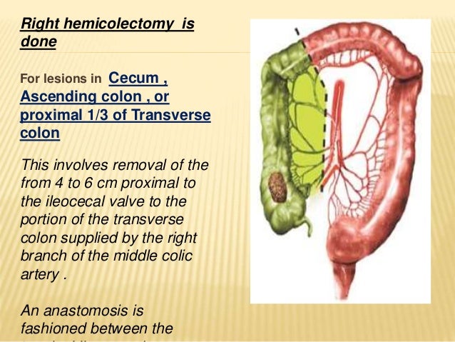 TREATMENT OF RIGHT COLONIC CANCER