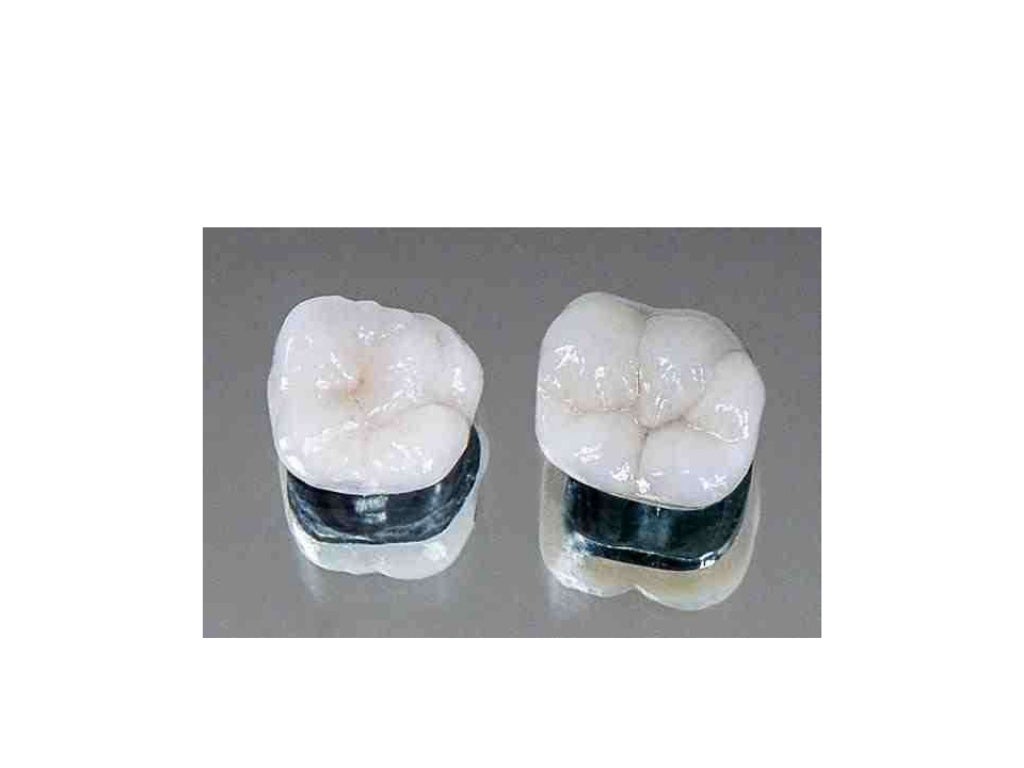 Dental ceramics and Applications)
