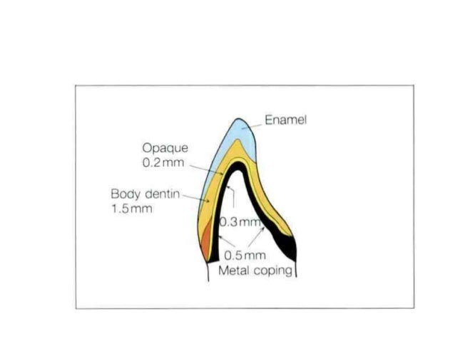 Dental Ceramics
