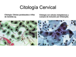 Citología Cervical
Citología: Células parabasales e hifas
de Cándida sp.
Citología con células metaplásicas y
cuerpos de i...