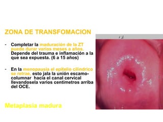ZONA DE TRANSFOMACION
- Completar la maduración de la ZT
puede durar varios meses a años.
Depende del trauma e inflamación...