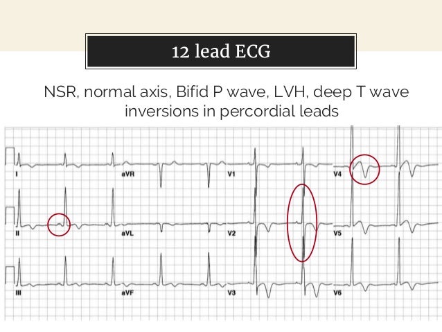 Cardiology 4.6. Hypertrophic Cardiomyopathy HCM - Dr. Farjad Ikram