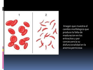 Imagen que muestra el
cambio morfologico que
produce la falta de
maduracion en los
eritrocitos y por
concecuencia su
disfuncionalidad en la
anemia perniciosa
 