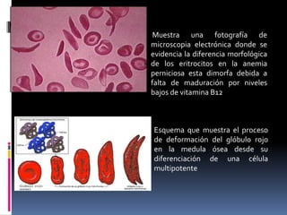 Muestra una fotografía de
microscopia electrónica donde se
evidencia la diferencia morfológica
de los eritrocitos en la anemia
perniciosa esta dimorfa debida a
falta de maduración por niveles
bajos de vitamina B12
Esquema que muestra el proceso
de deformación del glóbulo rojo
en la medula ósea desde su
diferenciación de una célula
multipotente
 
