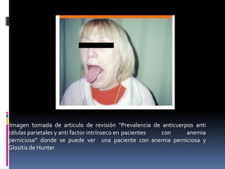 Imagen tomada de articulo de revisión “Prevalencia de anticuerpos anti
células parietales y anti factor intrínseco en pacientes con anemia
perniciosa” donde se puede ver una paciente con anemia perniciosa y
Glositis de Hunter
 