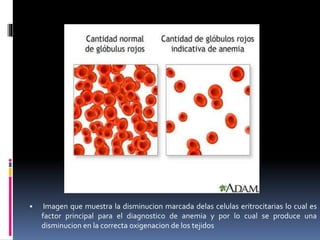  Imagen que muestra la disminucion marcada delas celulas eritrocitarias lo cual es
factor principal para el diagnostico de anemia y por lo cual se produce una
disminucion en la correcta oxigenacion de los tejidos
 