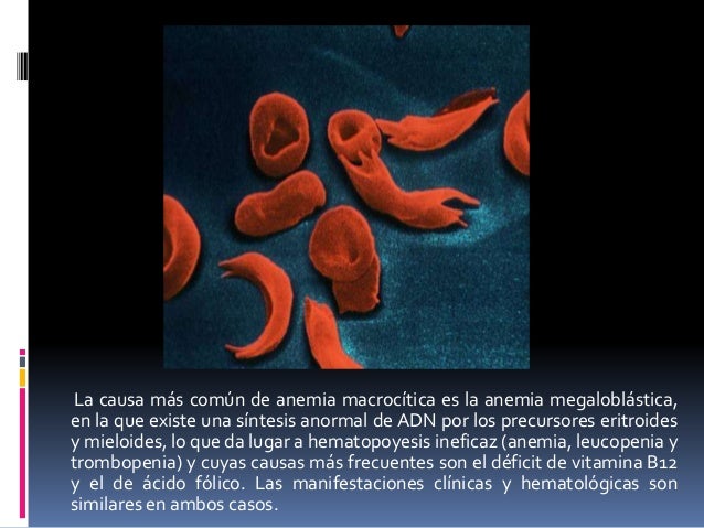 Anemia perniciosa