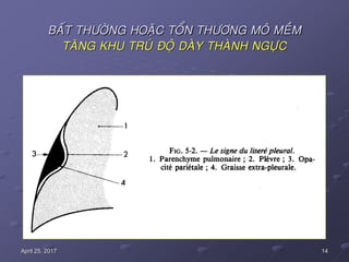 14April 25, 2017
BAÁT THÖÔØNG HOAËC TOÅN THÖÔNG MOÂ MEÀM
TAÊNG KHU TRUÙ ÑOÄ DAØY THAØNH NGÖÏC
 