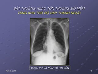 15April 25, 2017
BAÁT THÖÔØNG HOAËC TOÅN THÖÔNG MOÂ MEÀM
TAÊNG KHU TRUÙ ÑOÄ DAØY THAØNH NGÖÏC
BOÙNG VUÙ VAØ NUÙM VUÙ HAI BEÂN
 