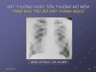 16April 25, 2017
BAÁT THÖÔØNG HOAËC TOÅN THÖÔNG MOÂ MEÀM
TAÊNG KHU TRUÙ ÑOÄ DAØY THAØNH NGÖÏC
BOÙNG CÔ NGÖÏC LÔÙN HAI BEÂN
 