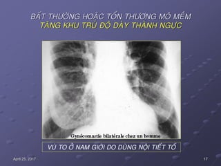 17April 25, 2017
BAÁT THÖÔØNG HOAËC TOÅN THÖÔNG MOÂ MEÀM
TAÊNG KHU TRUÙ ÑOÄ DAØY THAØNH NGÖÏC
VUÙ TO ÔÛ NAM GIÔÙI DO DUØNG NOÄI TIEÁT TOÁ
 