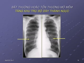 18April 25, 2017
BAÁT THÖÔØNG HOAËC TOÅN THÖÔNG MOÂ MEÀM
TAÊNG KHU TRUÙ ÑOÄ DAØY THAØNH NGÖÏC
 