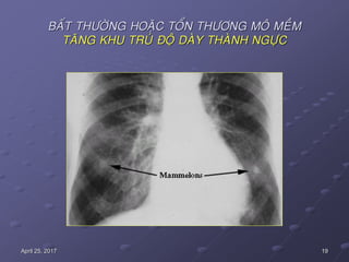 19April 25, 2017
BAÁT THÖÔØNG HOAËC TOÅN THÖÔNG MOÂ MEÀM
TAÊNG KHU TRUÙ ÑOÄ DAØY THAØNH NGÖÏC
 