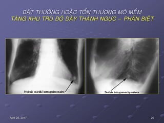20April 25, 2017
BAÁT THÖÔØNG HOAËC TOÅN THÖÔNG MOÂ MEÀM
TAÊNG KHU TRUÙ ÑOÄ DAØY THAØNH NGÖÏC – PHAÂN BIEÄT
 
