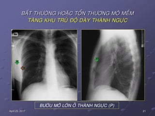 21April 25, 2017
BAÁT THÖÔØNG HOAËC TOÅN THÖÔNG MOÂ MEÀM
TAÊNG KHU TRUÙ ÑOÄ DAØY THAØNH NGÖÏC
BÖÔÙU MÔÕ LÔÙN ÔÛ THAØNH NGÖÏC (P)
 