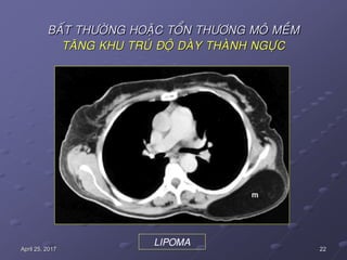22April 25, 2017
BAÁT THÖÔØNG HOAËC TOÅN THÖÔNG MOÂ MEÀM
TAÊNG KHU TRUÙ ÑOÄ DAØY THAØNH NGÖÏC
LIPOMA
 
