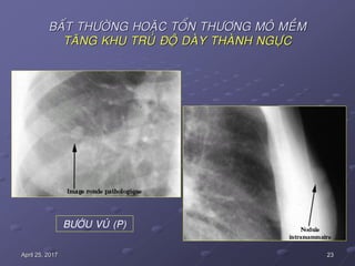 23April 25, 2017
BAÁT THÖÔØNG HOAËC TOÅN THÖÔNG MOÂ MEÀM
TAÊNG KHU TRUÙ ÑOÄ DAØY THAØNH NGÖÏC
BÖÔÙU VUÙ (P)
 