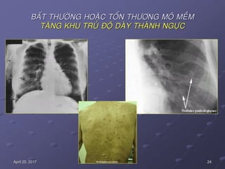 24April 25, 2017
BAÁT THÖÔØNG HOAËC TOÅN THÖÔNG MOÂ MEÀM
TAÊNG KHU TRUÙ ÑOÄ DAØY THAØNH NGÖÏC
 