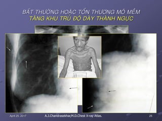 25April 25, 2017
BAÁT THÖÔØNG HOAËC TOÅN THÖÔNG MOÂ MEÀM
TAÊNG KHU TRUÙ ÑOÄ DAØY THAØNH NGÖÏC
A.J.Chandrasekhar,M.D.Chest X-ray Atlas.
 