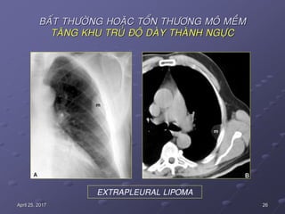 26April 25, 2017
BAÁT THÖÔØNG HOAËC TOÅN THÖÔNG MOÂ MEÀM
TAÊNG KHU TRUÙ ÑOÄ DAØY THAØNH NGÖÏC
EXTRAPLEURAL LIPOMA
 