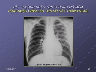 29April 25, 2017
BAÁT THÖÔØNG HOAËC TOÅN THÖÔNG MOÂ MEÀM
TAÊNG HOAËC GIAÛM LAN TOÛA ÑOÄ DAØY THAØNH NGÖÏC
 