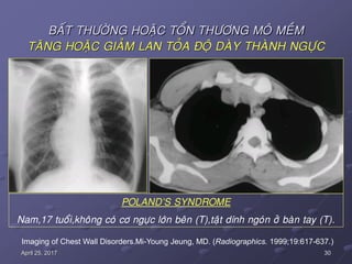 30April 25, 2017
BAÁT THÖÔØNG HOAËC TOÅN THÖÔNG MOÂ MEÀM
TAÊNG HOAËC GIAÛM LAN TOÛA ÑOÄ DAØY THAØNH NGÖÏC
Imaging of Chest Wall Disorders.Mi-Young Jeung, MD. (Radiographics. 1999;19:617-637.)
POLAND’S SYNDROME
Nam,17 tuoåi,khoâng coù cô ngöïc lôùn beân (T),taät dính ngoùn ôû baøn tay (T).
 