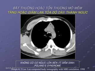 31April 25, 2017
BAÁT THÖÔØNG HOAËC TOÅN THÖÔNG MOÂ MEÀM
TAÊNG HOAËC GIAÛM LAN TOÛA ÑOÄ DAØY THAØNH NGÖÏC
KHOÂNG COÙ CÔ NGÖÏC LÔÙN BEÂN (T) BAÅM SINH:
POLAND’S SYNDROME
Joseph K.T.Lee. Lee computed body tomography with MRI correlation. 1998
 