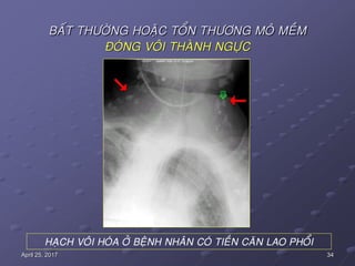 34April 25, 2017
BAÁT THÖÔØNG HOAËC TOÅN THÖÔNG MOÂ MEÀM
ÑOÙNG VOÂI THAØNH NGÖÏC
HAÏCH VOÂI HOÙA ÔÛ BEÄNH NHAÂN COÙ TIEÀN CAÊN LAO PHOÅI
 